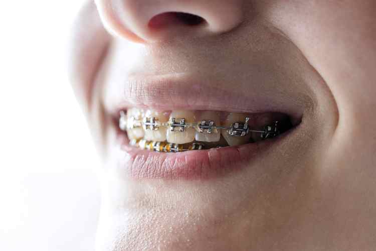 Traditional Metal Braces